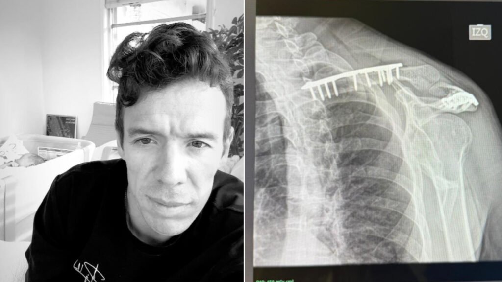 ¡Tremenda 'chamba'! Rigoberto Urán muestra la cicatriz que le dejó su insólito accidente con la bicicleta de su hija