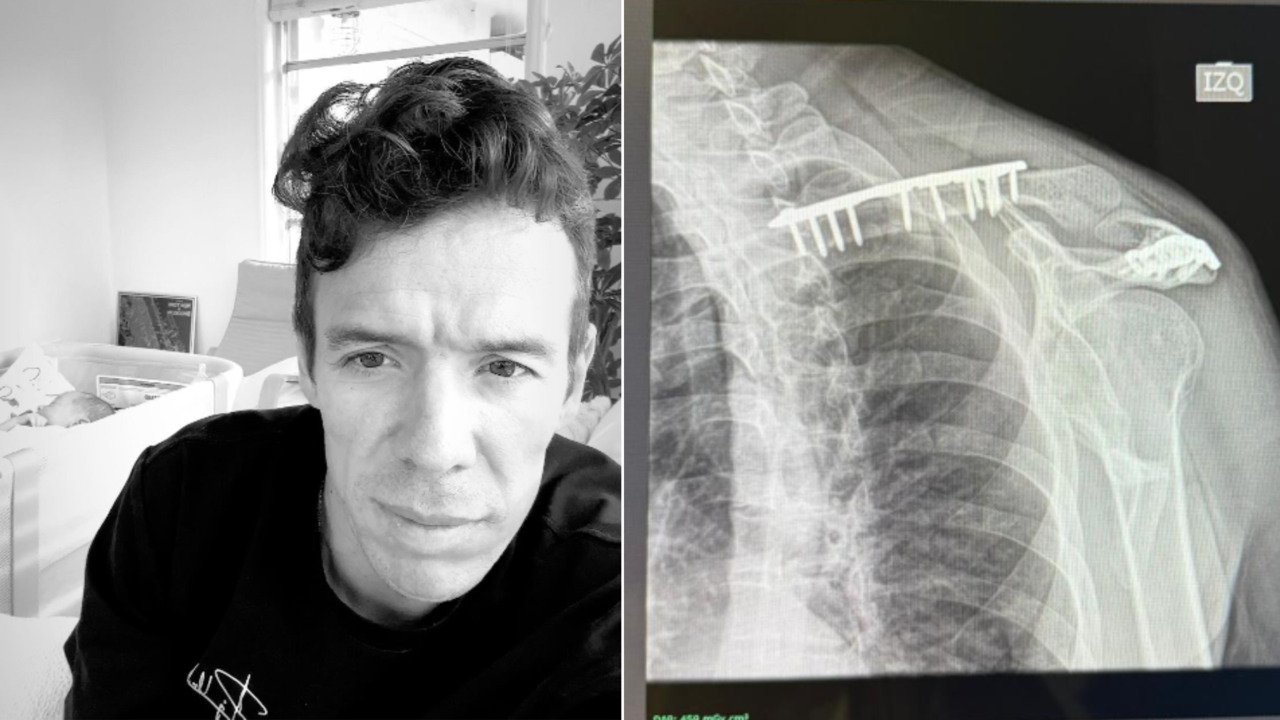 ¡Tremenda 'chamba'! Rigoberto Urán muestra la cicatriz que le dejó su insólito accidente con la bicicleta de su hija
